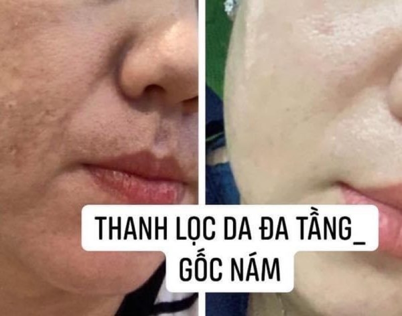 Thanh Lọc Da Đa Tầng