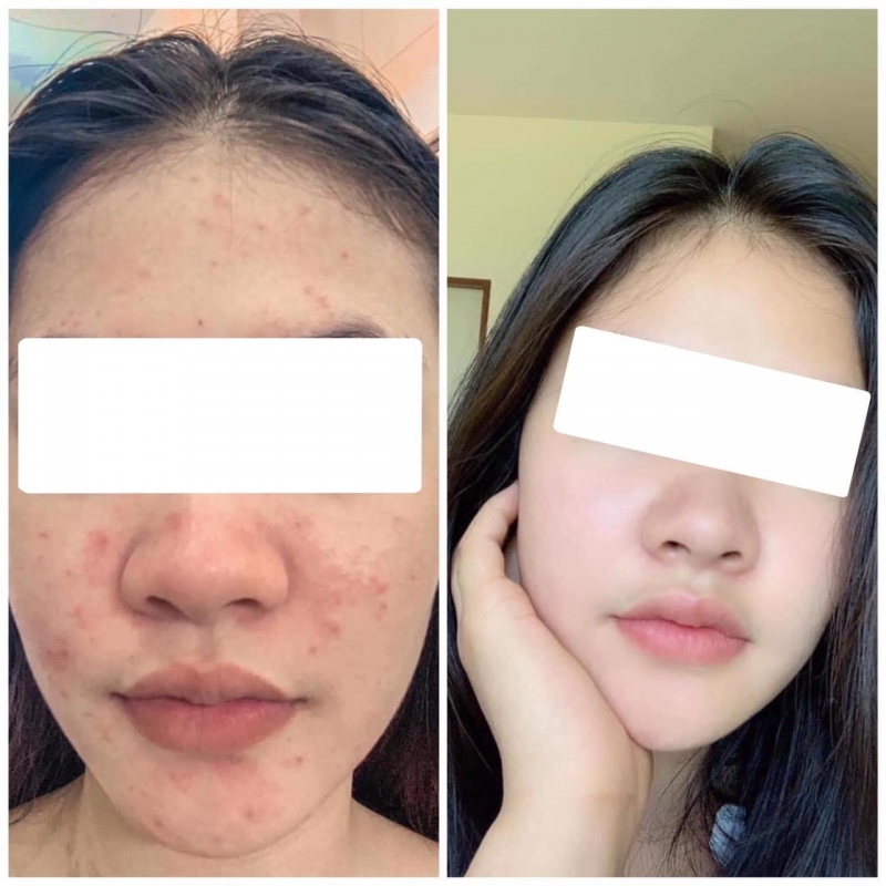 Etre Belle Skin Detox Cure Therapy Tripple Perfect Purifying Acne Ampoule Tinh chất trị mụn viêm, ổn định dầu và se khít chân lông