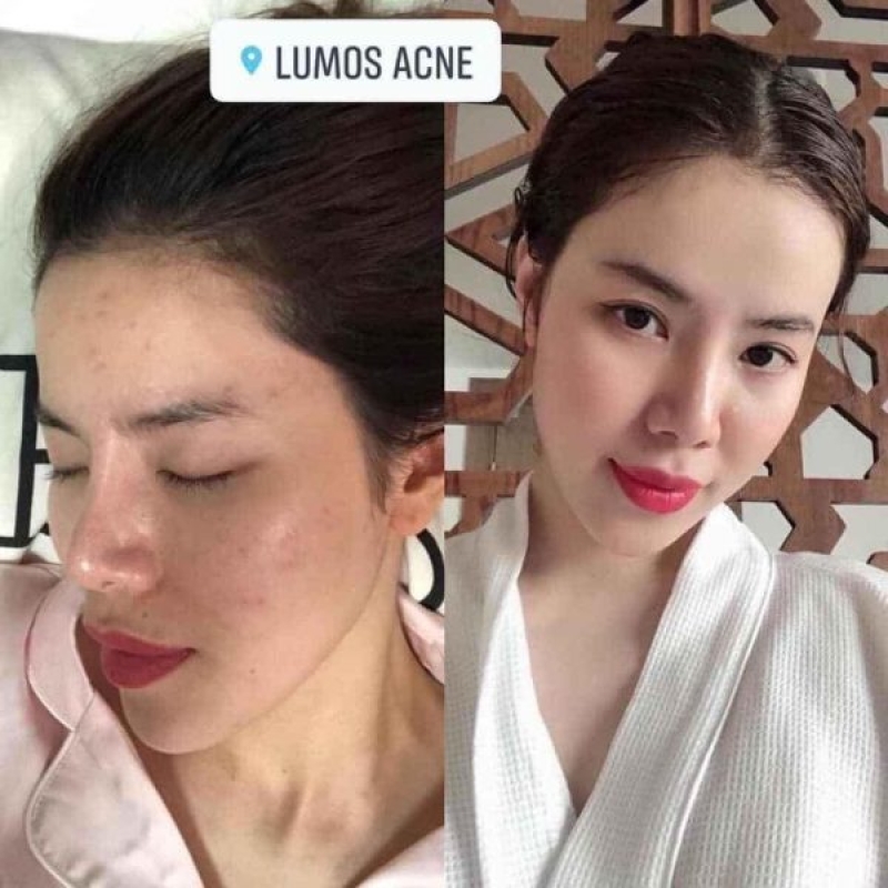 Lumos Acne Serum Trị Mụn Thâm